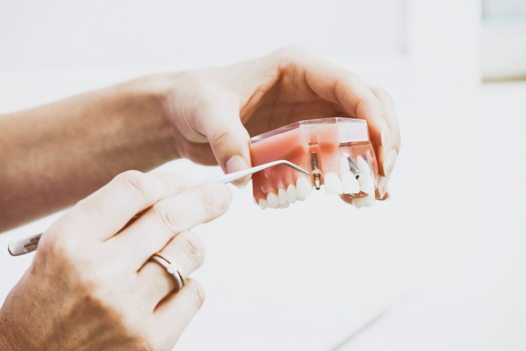 Implants dentaires