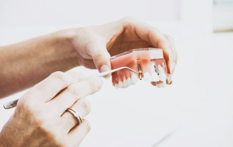 Implants dentaires
